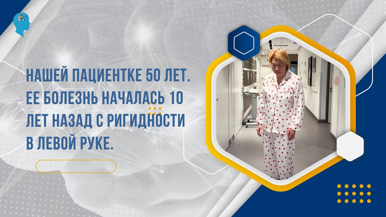 Нашей пациентке 50 лет. Ее болезнь началась 10 лет назад с ригидности в левой руке.