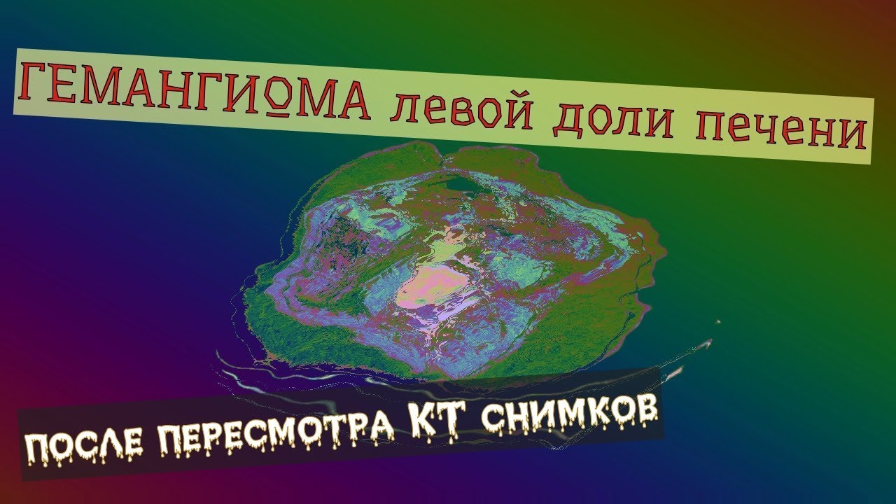 ГЕМАНГИОМА левой доли печени на КТ расшифровке брюшной полости