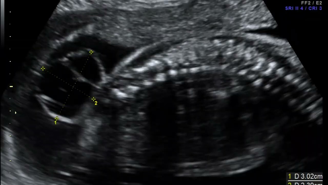 Ultrasonografía en mielomeningocele fetal