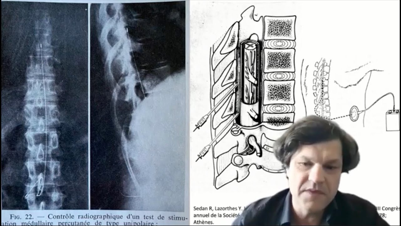 Petite histoire de la neuromodulation dans le traitement de la douleur