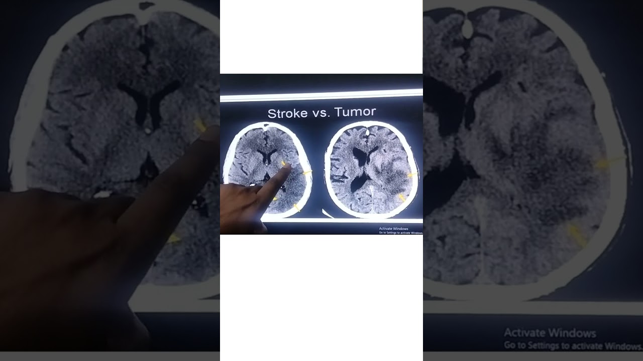 Brain pathology