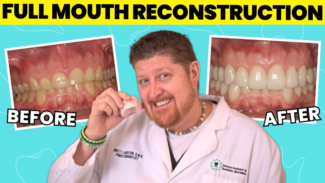 What REALLY Happens in a Full Mouth Reconstruction | Dr. Brett Langston