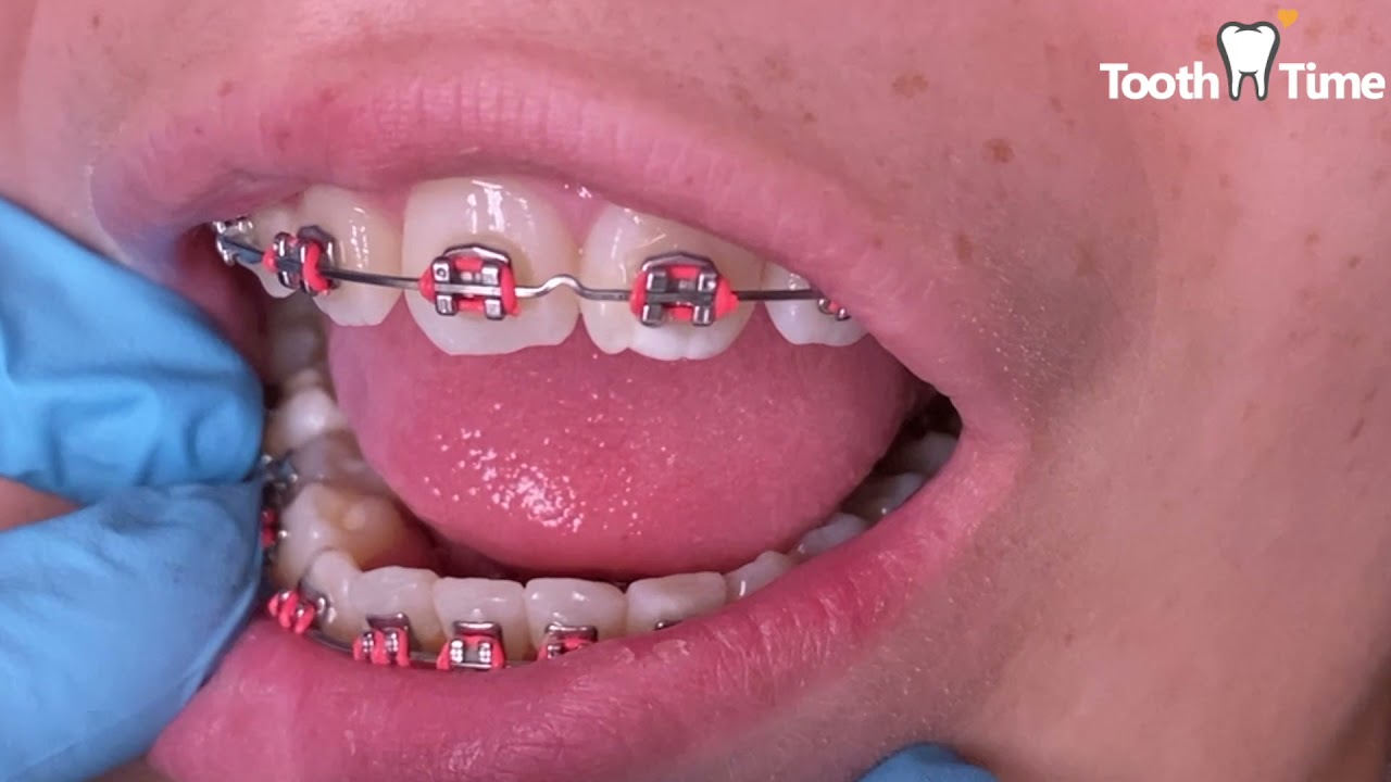 Braces deep bite - Getting Bite Turbos on front teeth - Tooth Time Family Dentistry New Braunfels