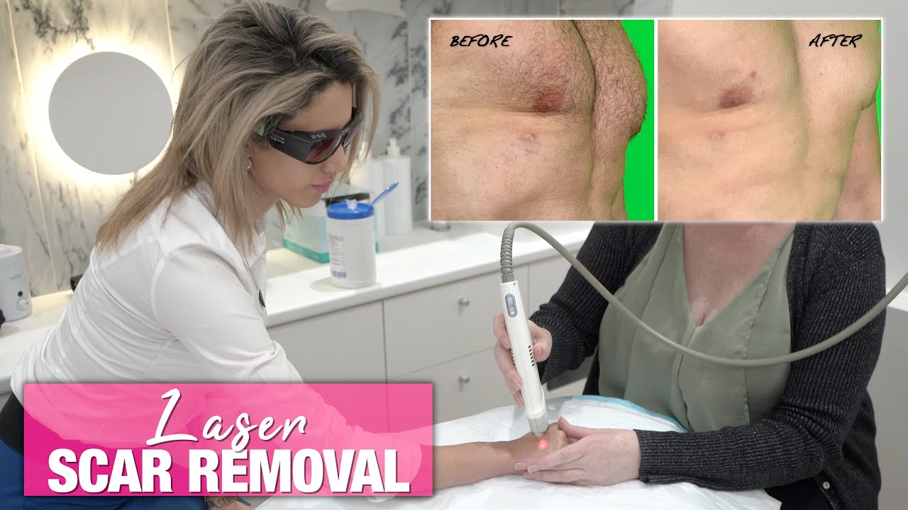 How to Remove Surgical & Acne Scars | Doctor Explains Excel V+ Skin Care