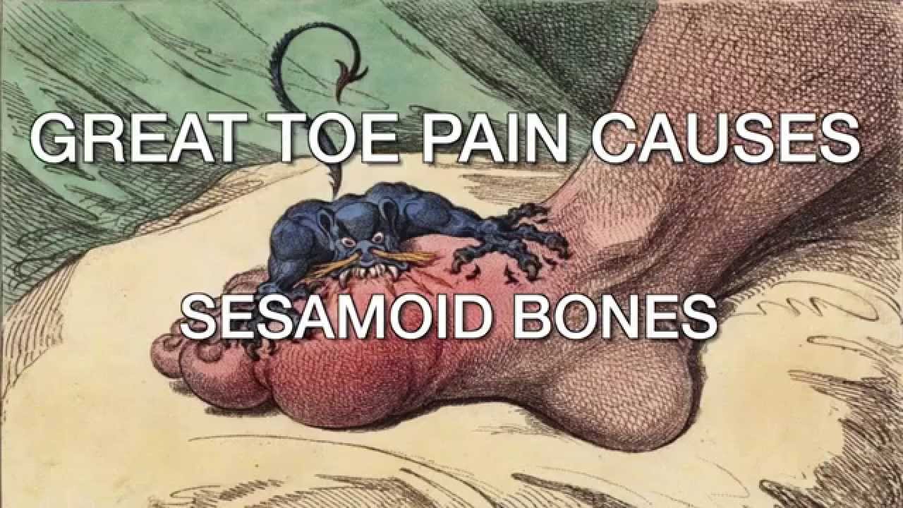 Dr.  Lake's Tips: Great Toe Pain Causes - Sesamoid Bones