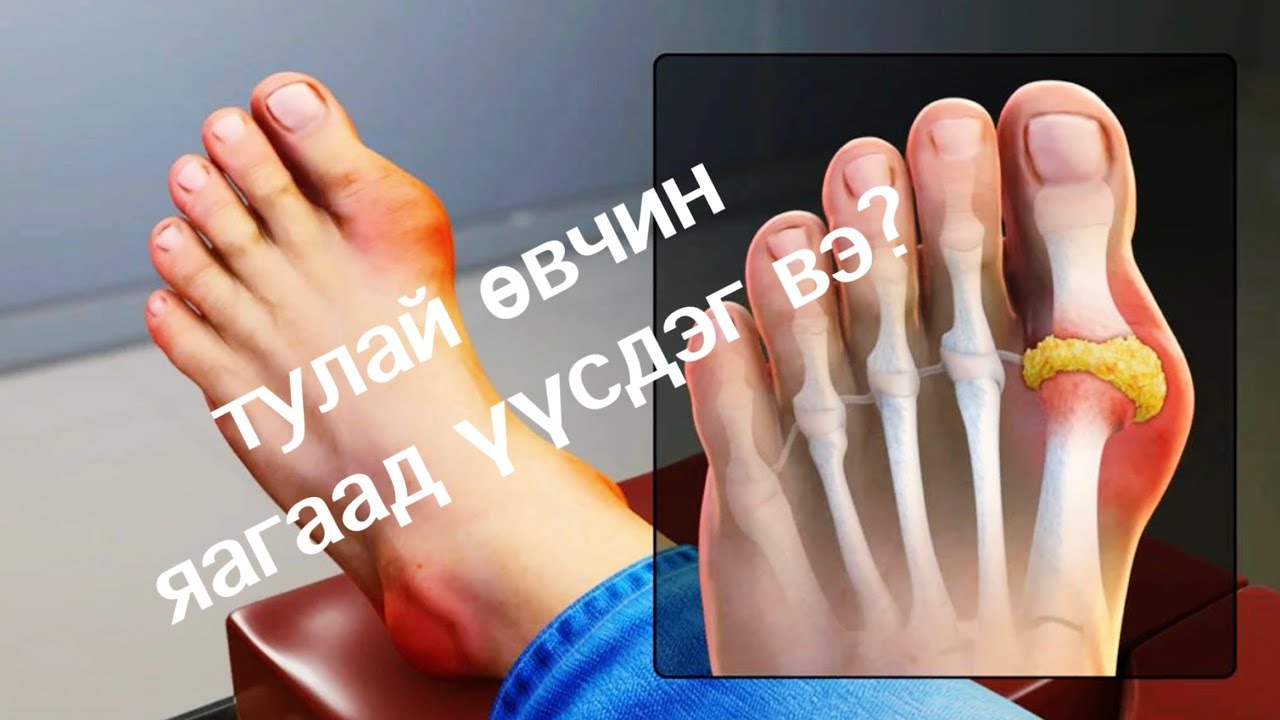 тулай өвчин яаж үүсдэг вэ? ямар шинж тэмдэгээр илэрдэг вэ?
