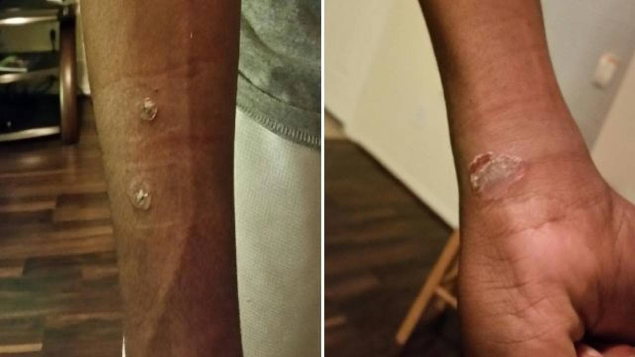Students diagnosed with staph infections