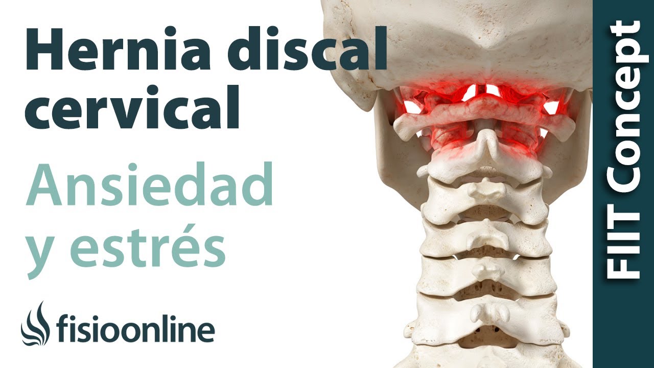 Hernia discal cervical izquierda y su relación con la ansiedad y el estrés