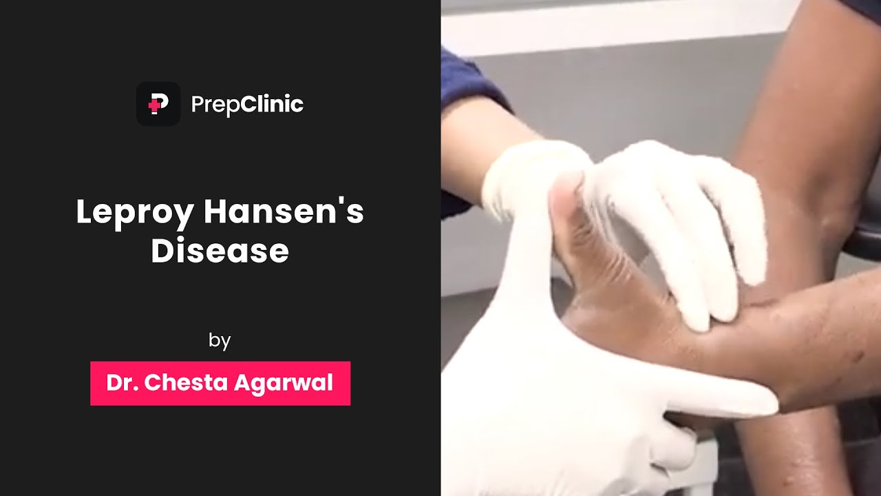 Болезнь Лепроя Хансена | Доктор Честа Агарвал | PrepClinic Дерматология