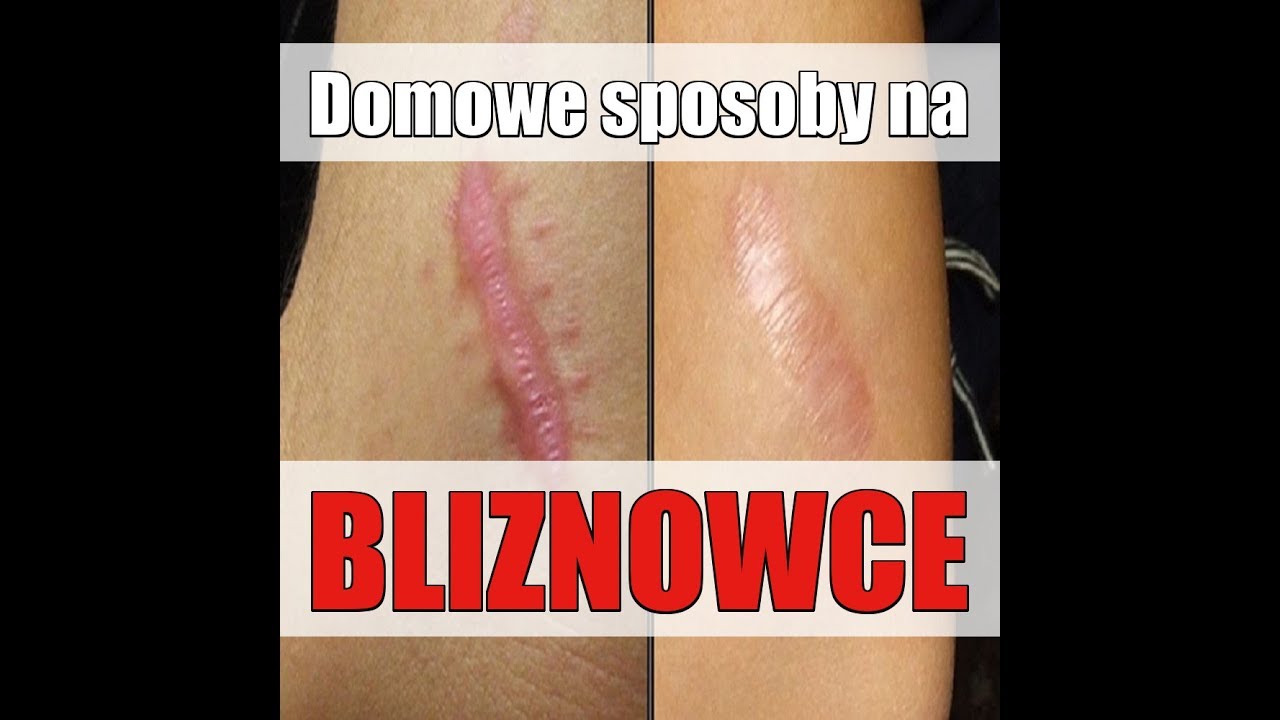 Bliznowce - Domowe sposoby na bliznowce