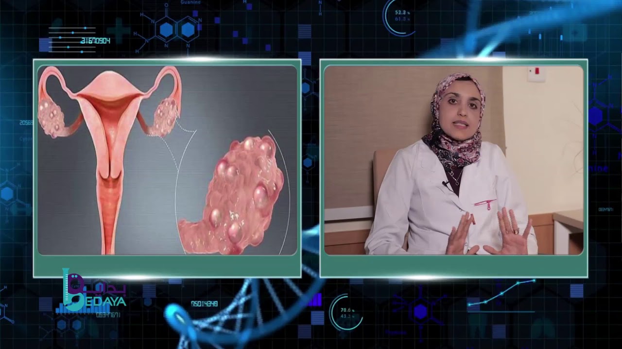 هل تؤثر تكيس المبايض على نجاح الحقن المجهرى ؟