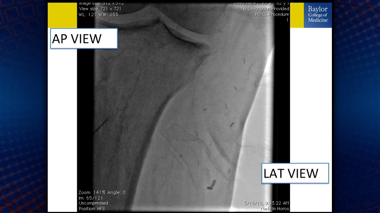 Техника малоберцового доступа: как я это делаю и когда следует ее применять?