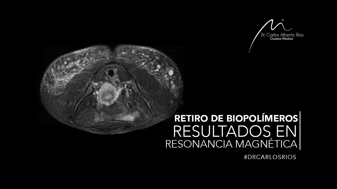 Retiro de Biopolímeros | Resultados en Resonancia Magnética