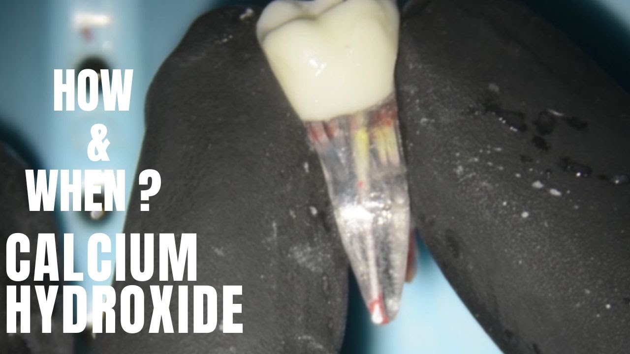 When and How to use Calcium hydroxide in Endodontics - Various ways to use  Waldent Calcium hydroxid