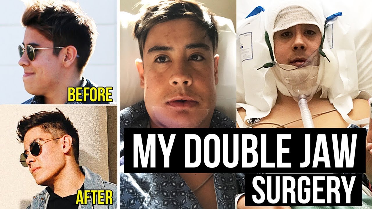I HAD JAW SURGERY | MY DOUBLE JAW SURGERY EXPERIENCE *BEFORE & AFTER PHOTOS*