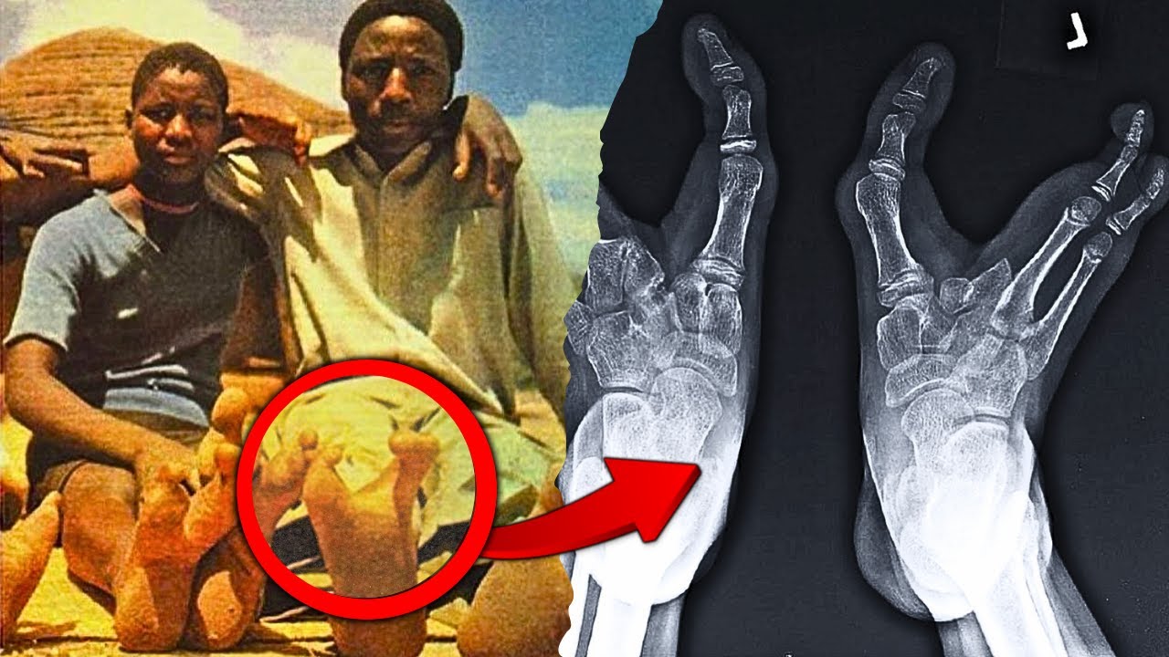 Zimbabwe Tribe With Two Toed  Ostrich Feet