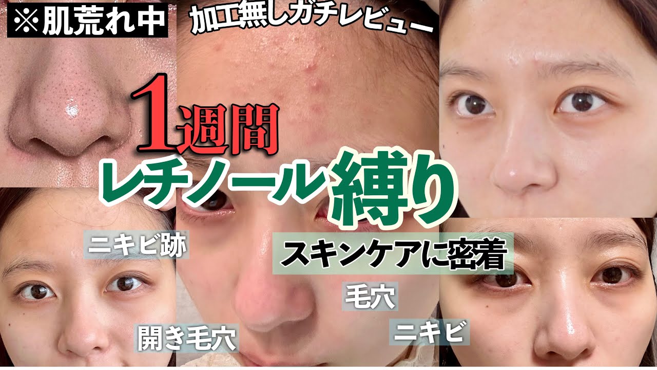 【一週間レチノール縛りスキンケア】肌の調子が悪かったのでスキンケア密着！！レチノールの注意点も解説します！ニキビ跡/ニキビケア/毛穴詰まり【スキンケア】