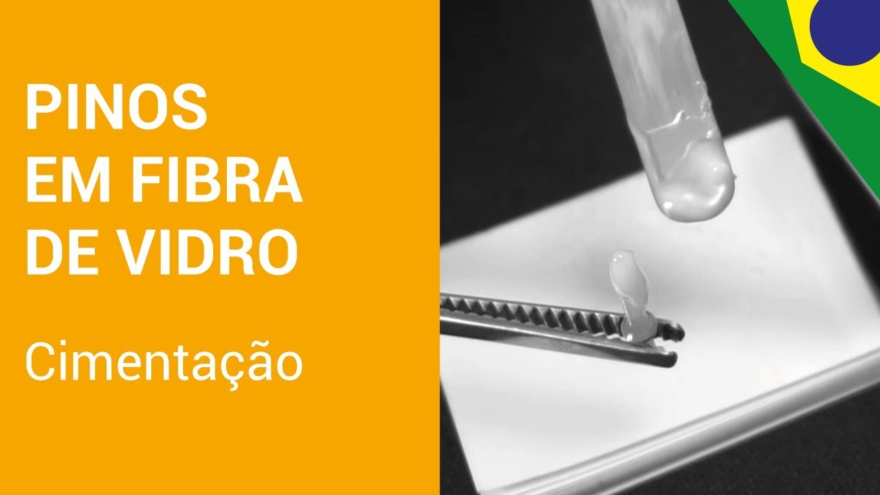Cimentação de Pinos em Fibra de Vidro