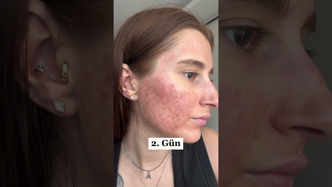 fraksiyonel lazer #keşfet #fractionalco2laser