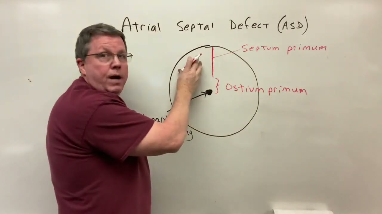 Atrial Septal Defect A Simple Explanation