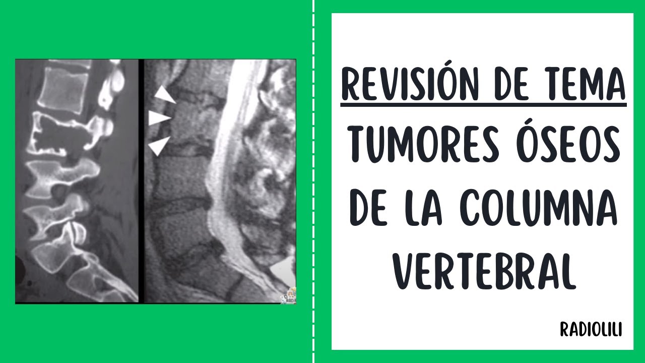 Tumores Óseos de la Columna Vertebral: Revisión de Tema Radiológico.