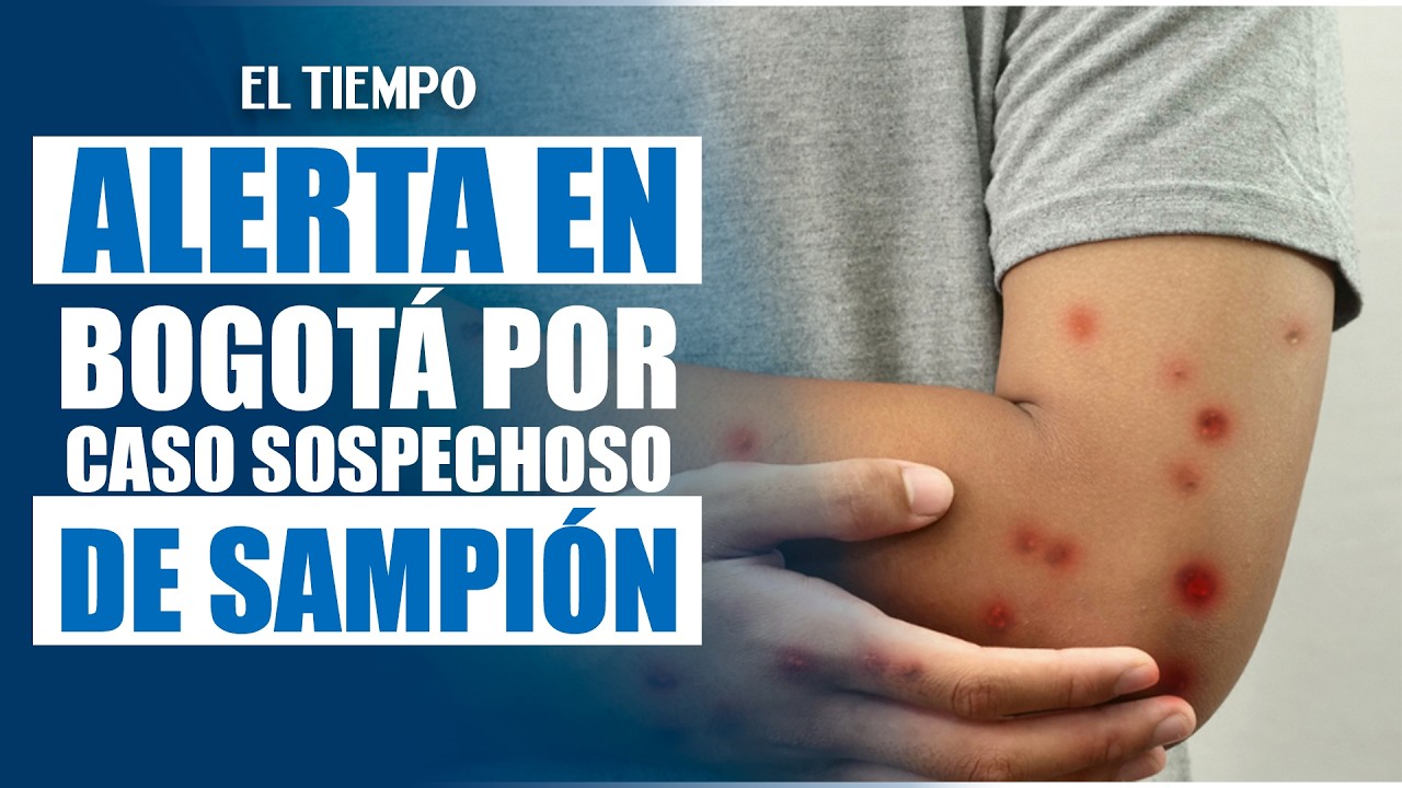 Alerta en Bogotá por caso sospechoso de sarampión: síntomas y claves para identificarlo| EL TIEMPO
