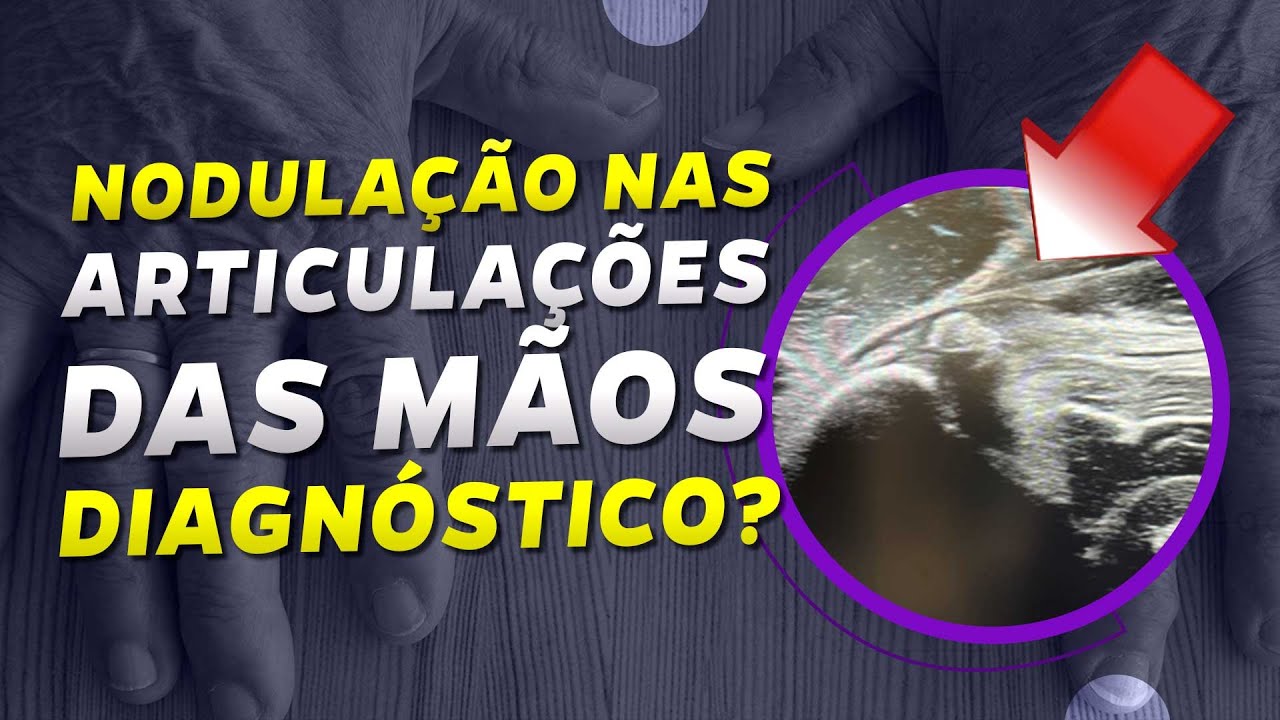 Ultrassom nas articulações das mãos. Qual é o seu diagnóstico? - MSKD Casos 37