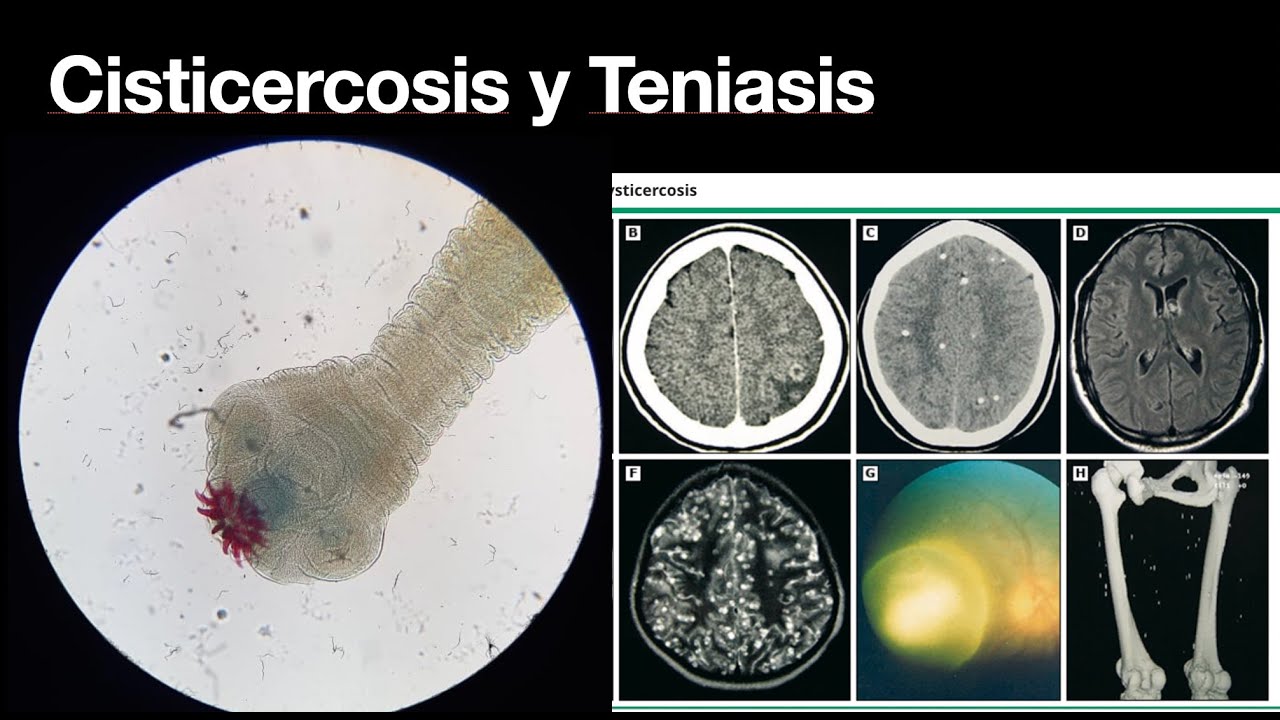 Cisticercosis y Teniasis intestinal - Conoce la enfermedad - Parasitos