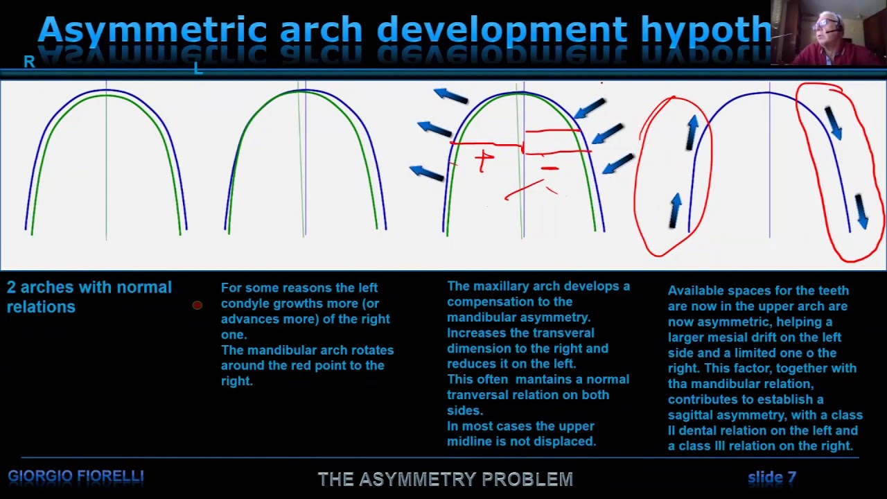 Clip from a Webinar on the Treatment of Asymmetric cases.
