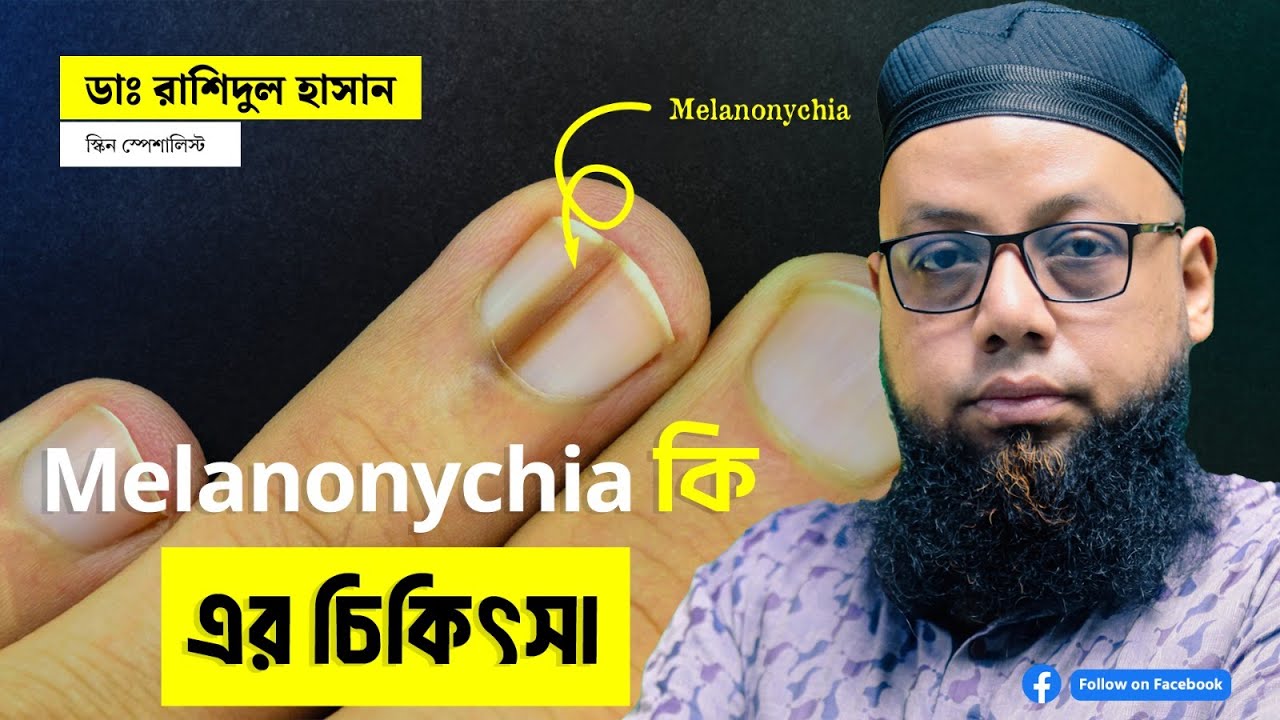 melanonychia/ নখের রং পরিবর্তন হয়ে যাওয়া,কারন, চিকিৎসা, উদ্বিগ্নতার বিষয়