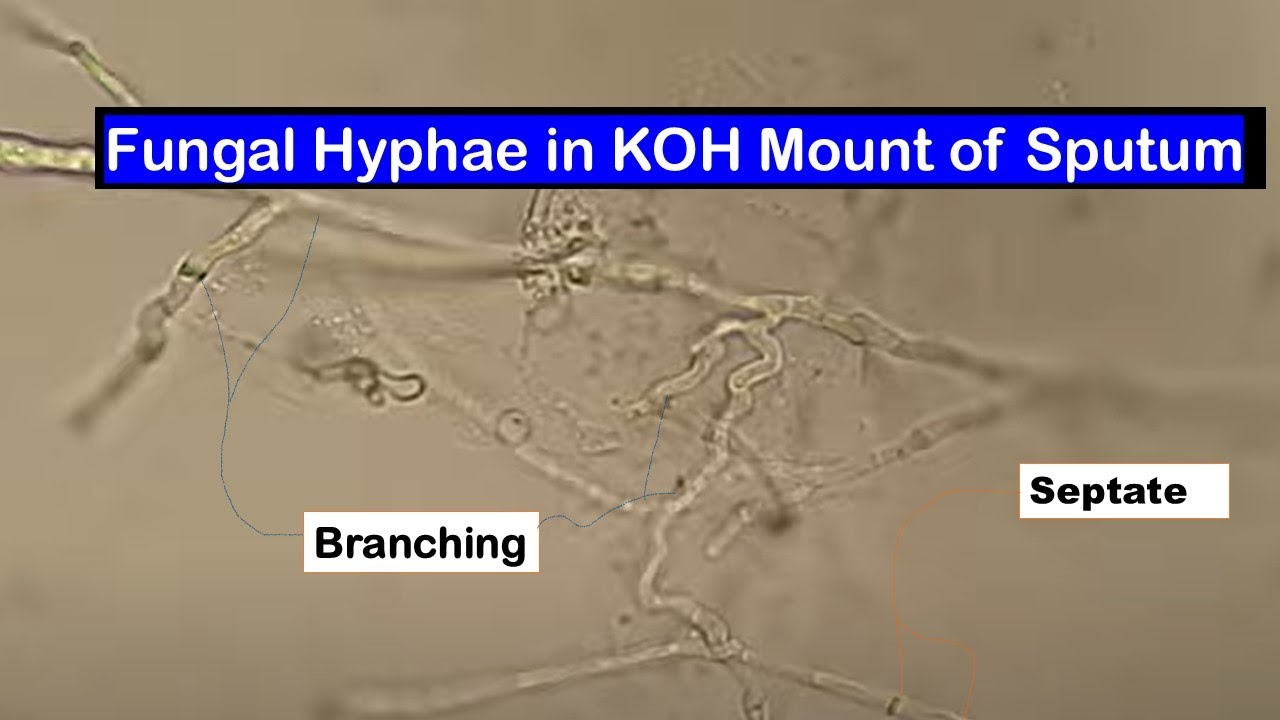 Observation of Septate Branching Fungal Hyphae in KOH Mount of Sputum Sample