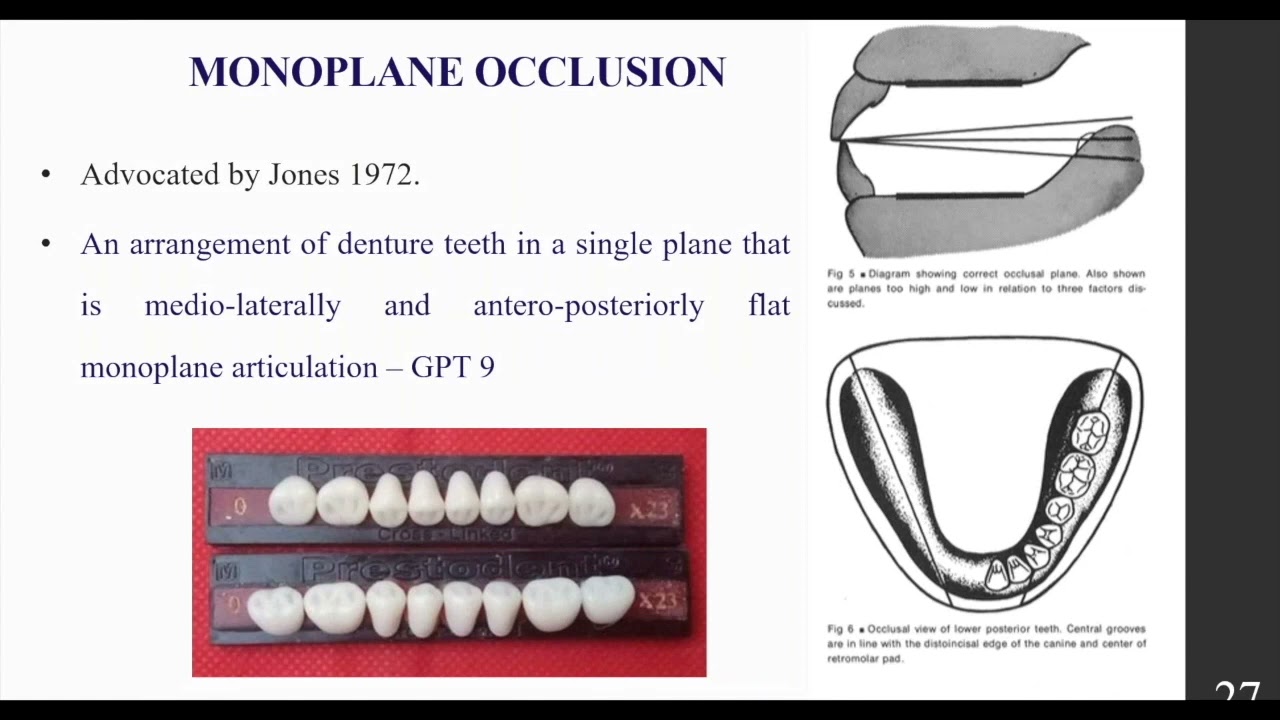 Complete denture Part VII Occlusal concepts in complete denture  by Dr  Raisa and guided by Dr  Hema