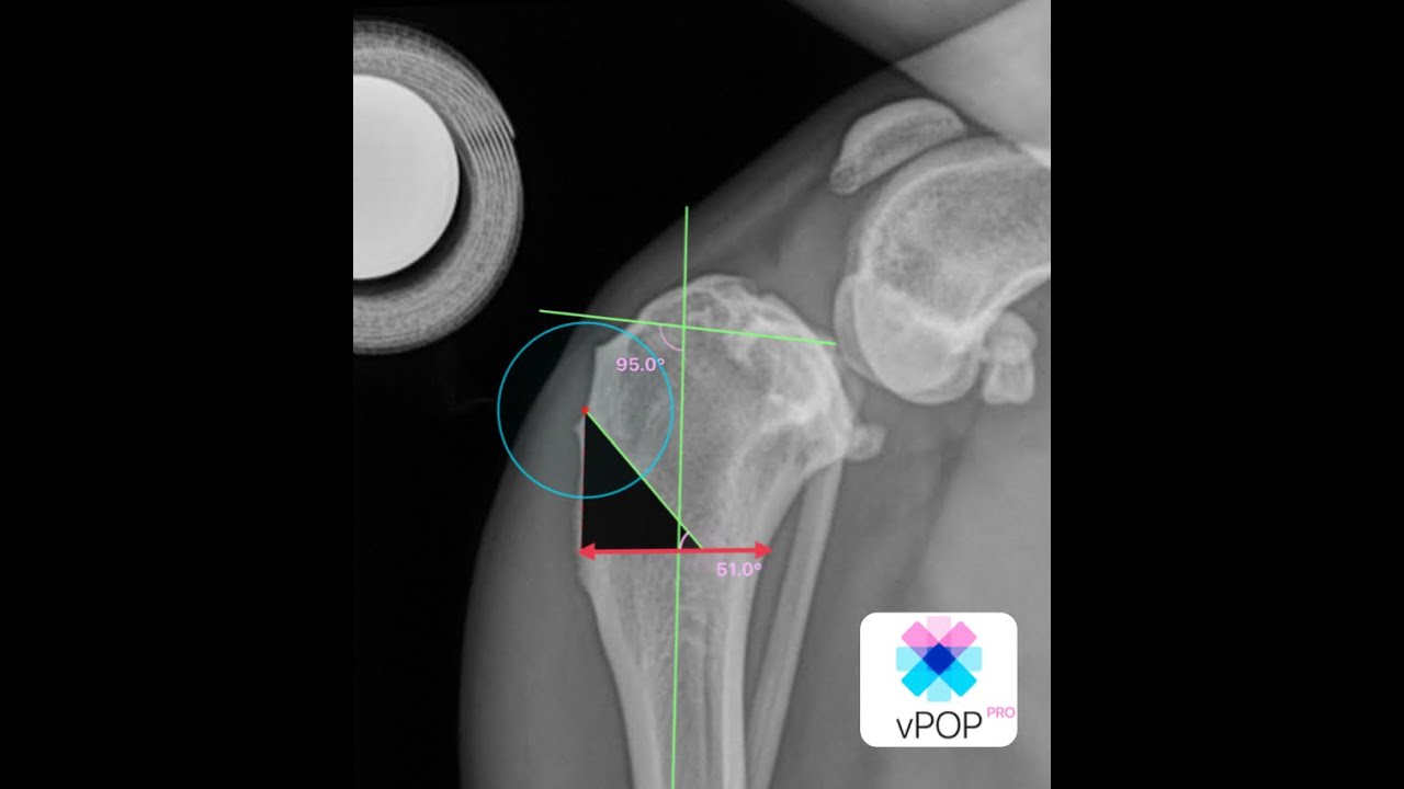 How to plan a MCCWO modified cranial closing wedge ostectomy in vPOP PRO ® eTPA series no.1