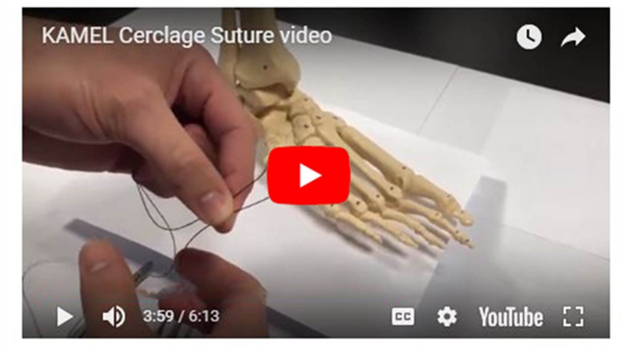 Dr Benjamin Kamel - Cerclage Suture Technique