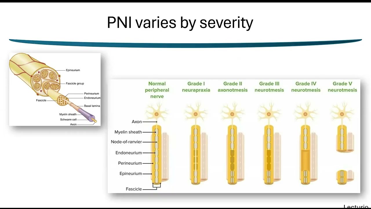 Injury Specific Effect of Schwann Cell-Derived Exosome Treatment for Peripheral Nerve Injury