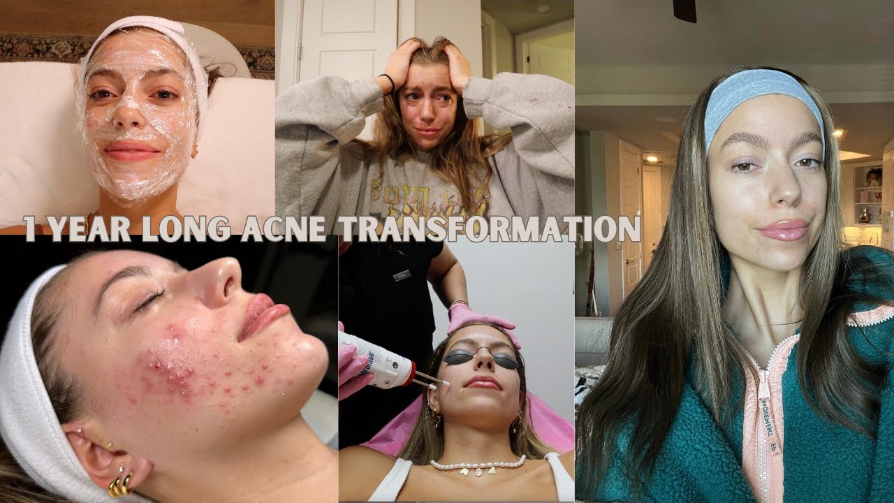 1 year long SKIN TRANSFORMATION *real & raw* (no accutane)