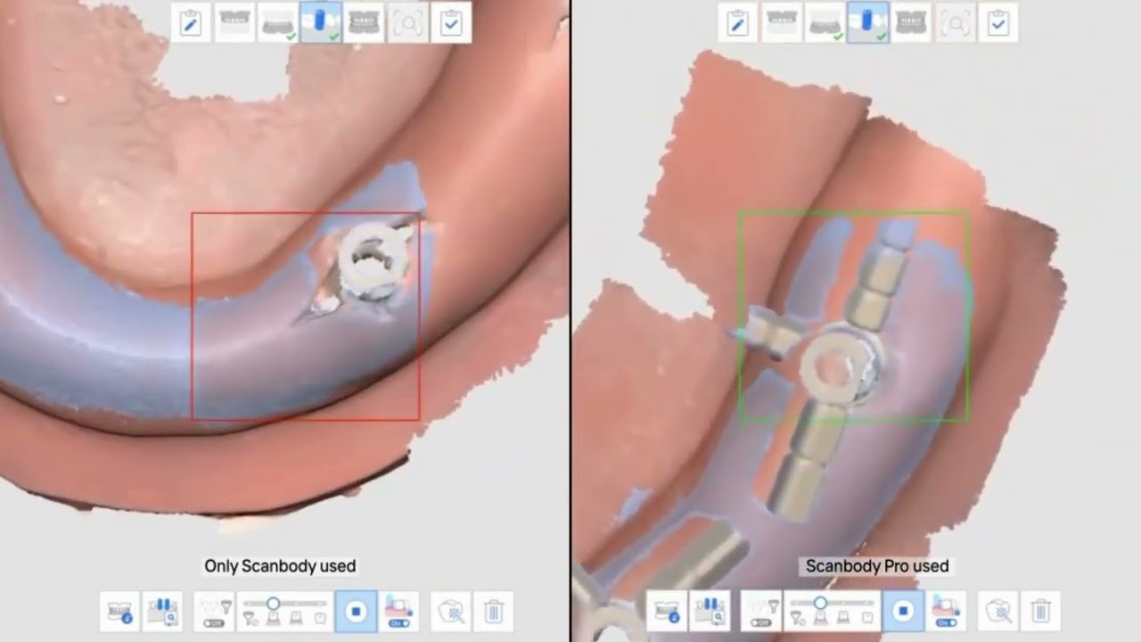 Video scanbody pro vs only scanbody by Dentis
