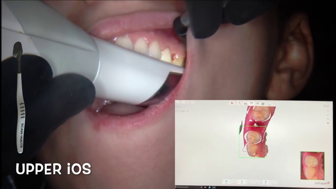 Scan-Mate Demo by Dr. Isaac Tawil