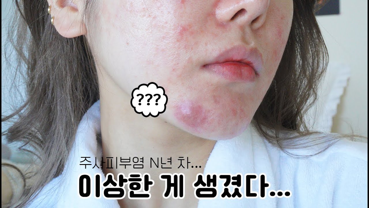 피부 근황....🙄 요즘 피부를 위해 하는 노력들 *더러움 주의