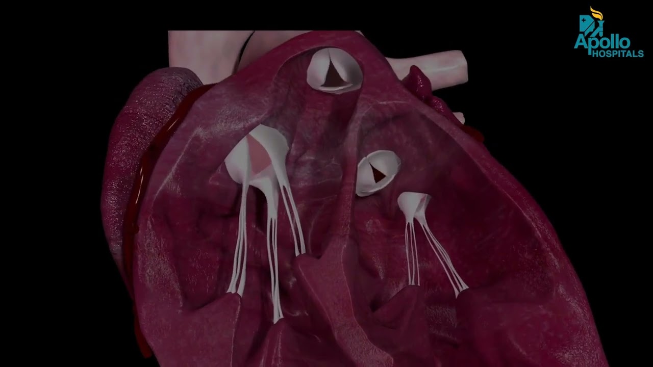 What Is Heart Valve Repair? | Doctor Explains Simply