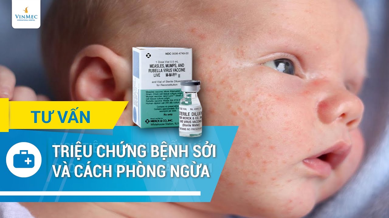 Triệu chứng bệnh sởi và tiêm vacxin sởi phòng ngừa bệnh