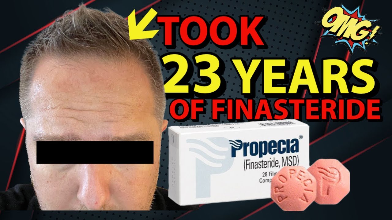 HE TOOK FINASTERIDE FOR 23 YEARS AND THIS IS WHAT HAPPENED.
