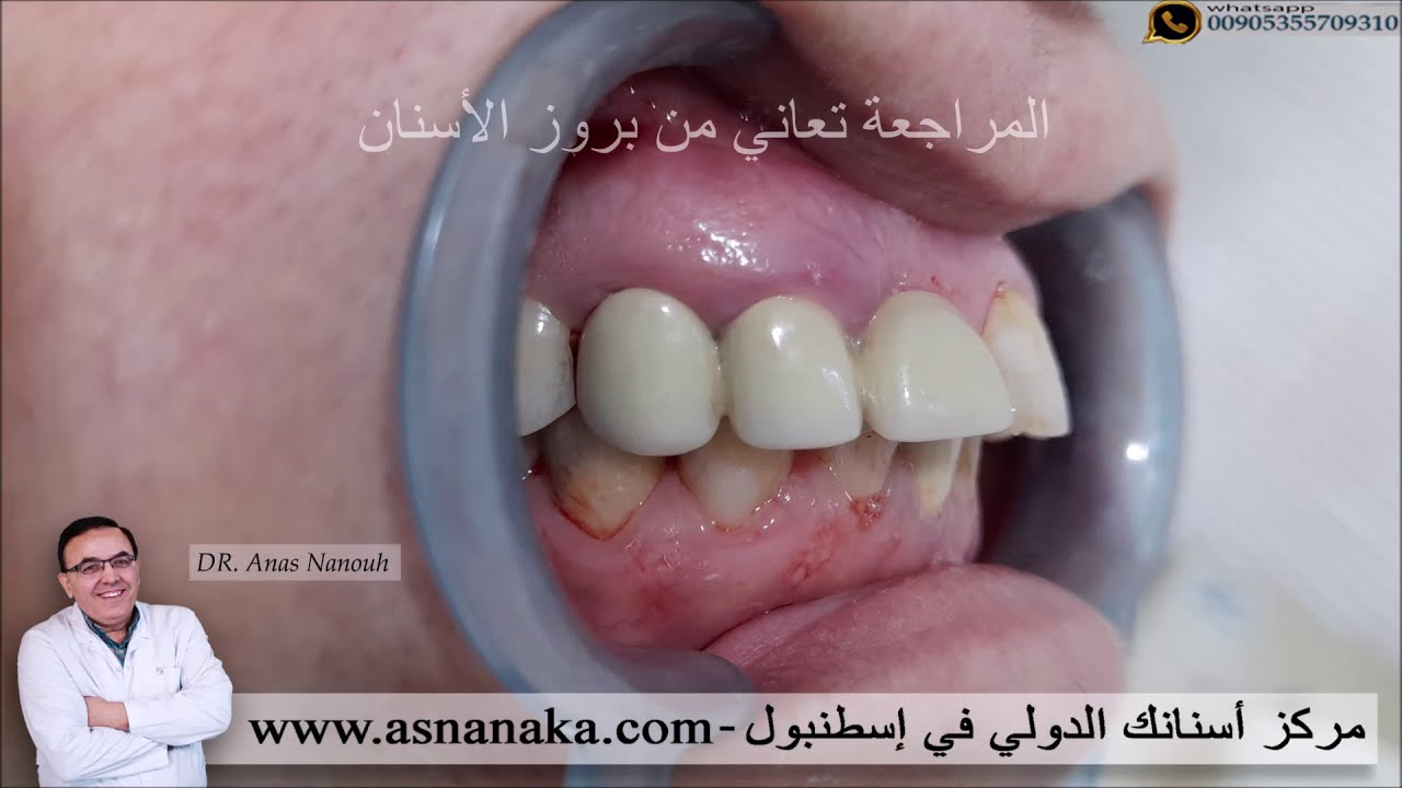 تركيب إبتسامة هوليود لمراجعة عراقية  تعاني من بروز وتفرق الأسنان