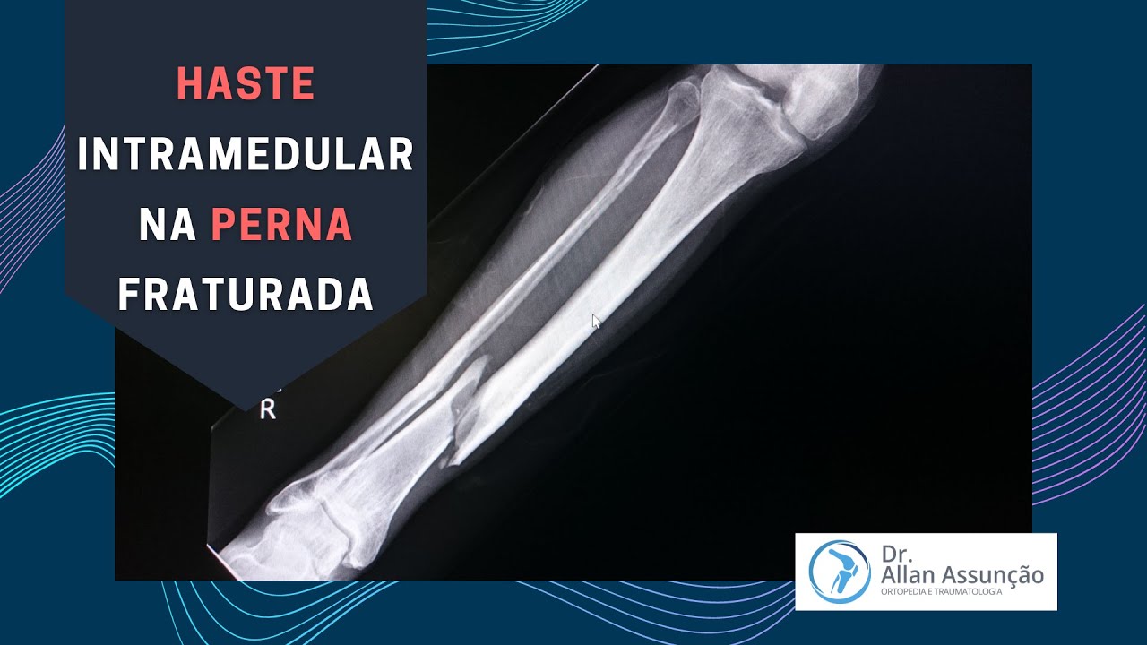 Colocação de haste intramedular na perna que sofre fratura