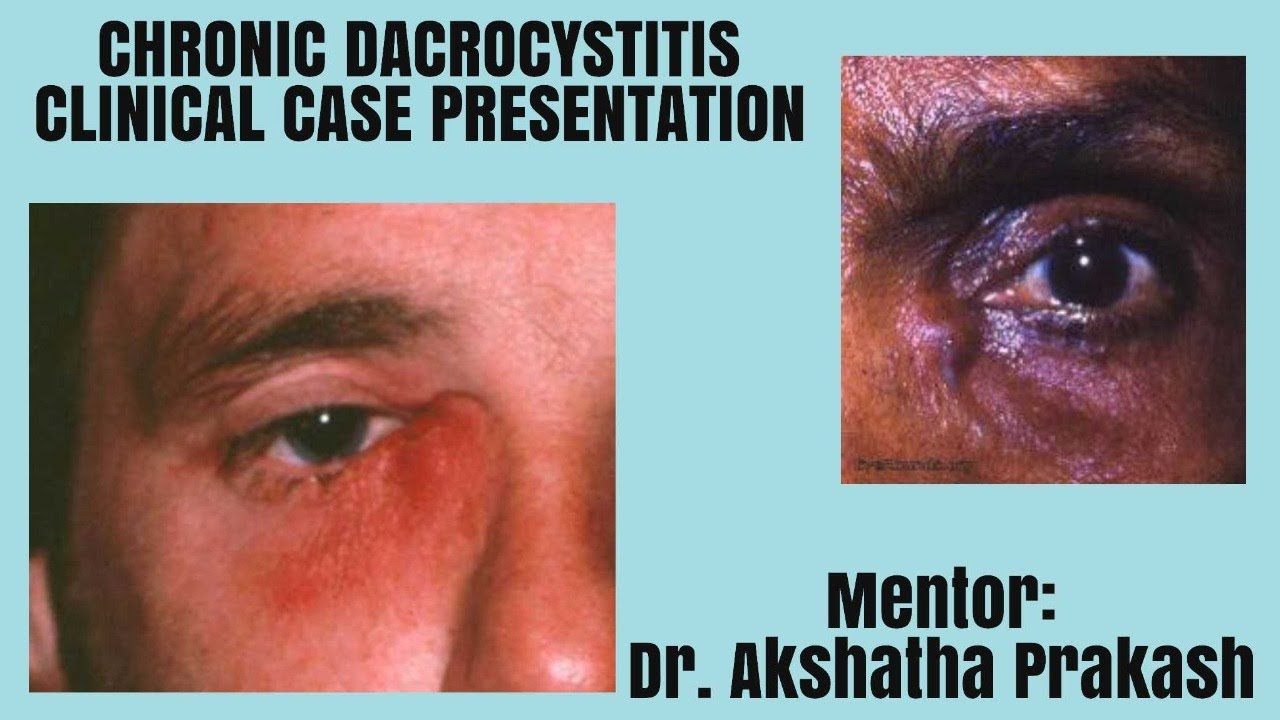 CHRONIC DACROCYSTITIS Clinical Case Presentation