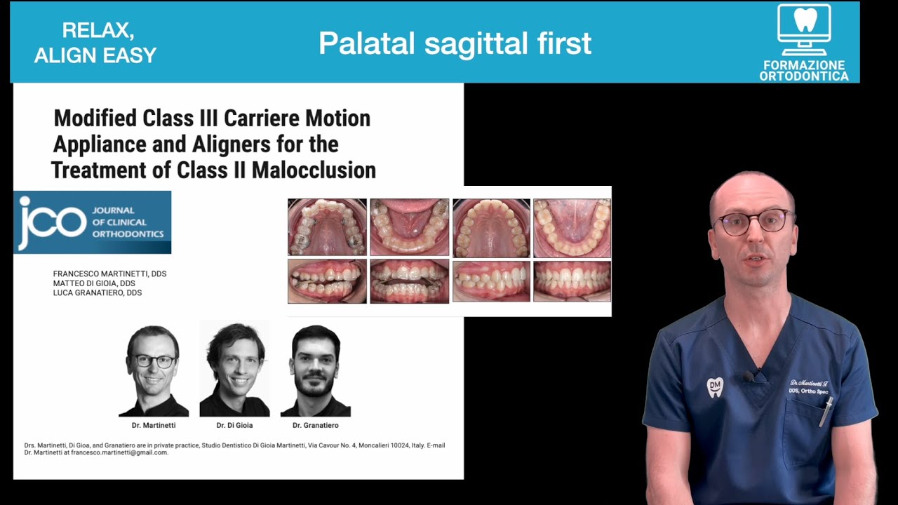🇬🇧 Palatal Carriere Motion: A New Technique for Class II Correction with Aligners