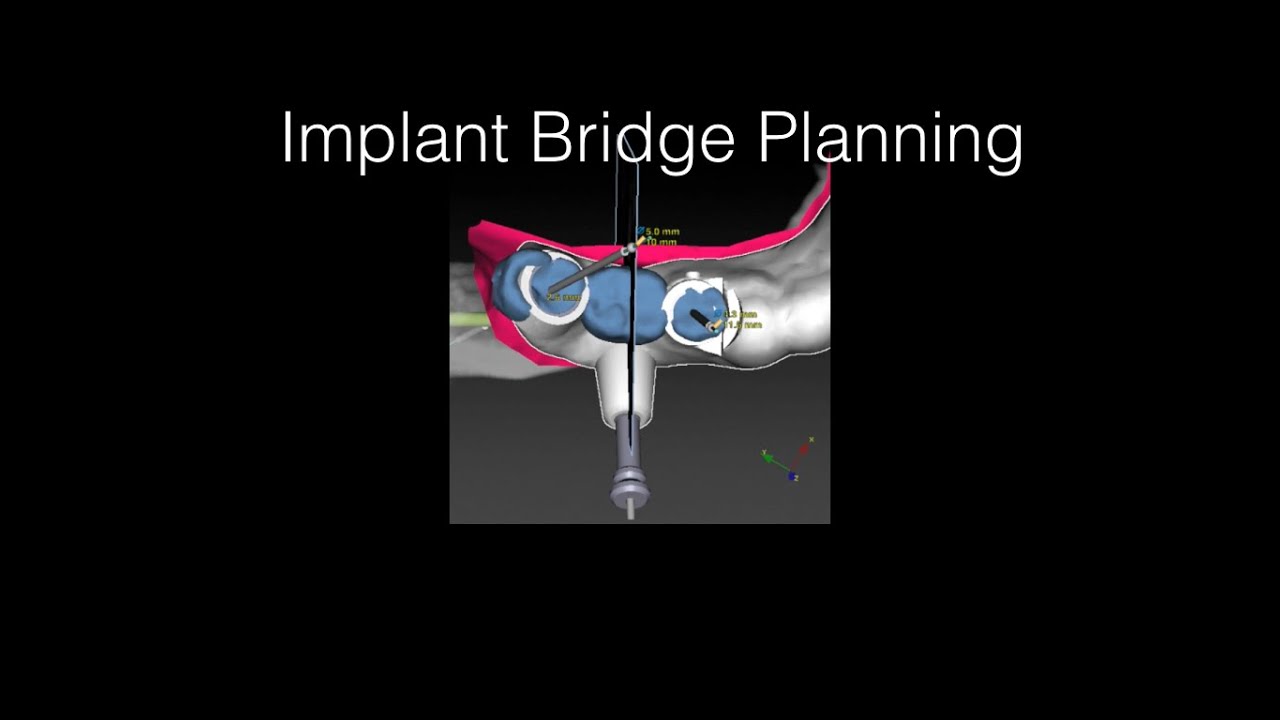 For Dentists only! - Part 1 - Dental Implant Planning Session Molar bridge