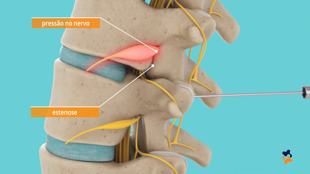 Animação: Estenose do Canal Vertebral via Endoscópica