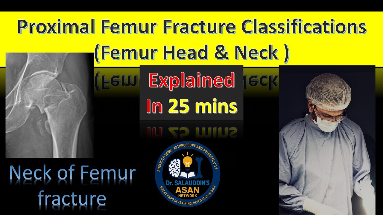 Proximal Femur Fracture Classification | Femoral Head & Neck Fractures Explained |Asan Network Ortho