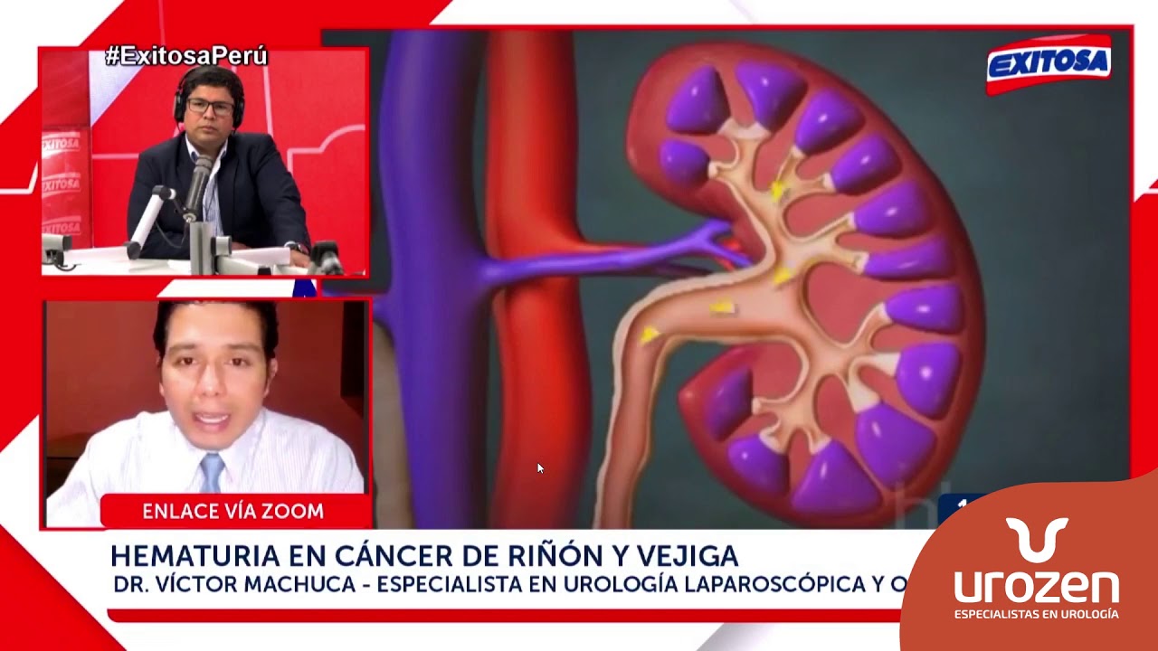 Hematuria en cáncer de riñón y vejiga  |  Dr. Víctor Machuca